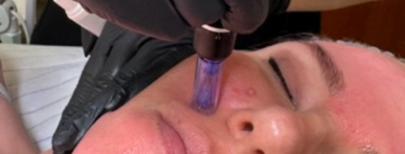 Mitä on mikroneulaus ja mitä olet halunnut tietää siitä?