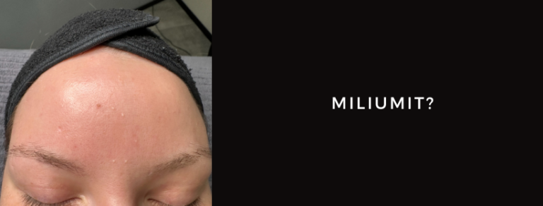 Miliumit – mitä ne ovat ja miten niistä pääsee eroon?